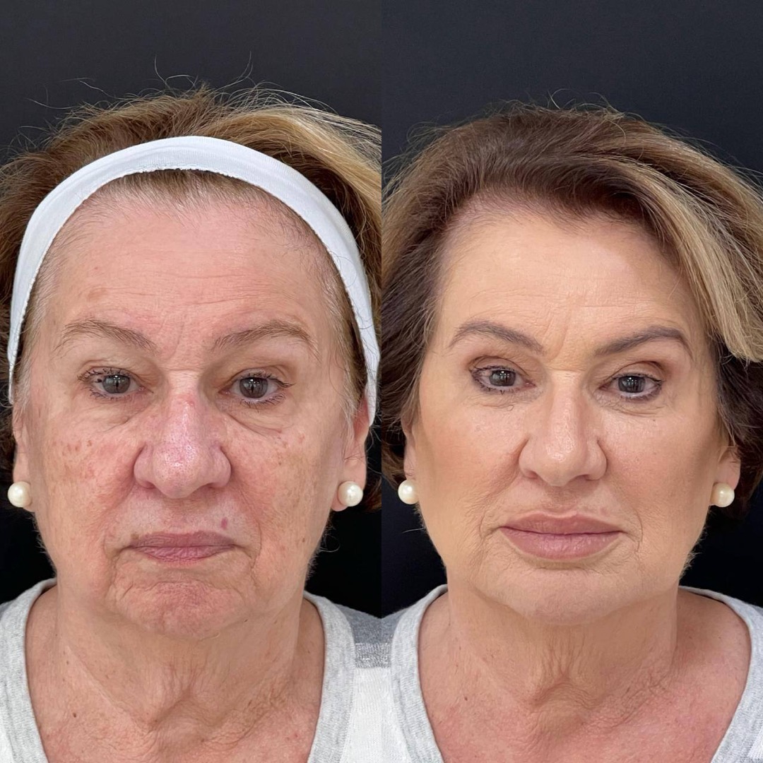 Antes e depois — Clínica Fischer