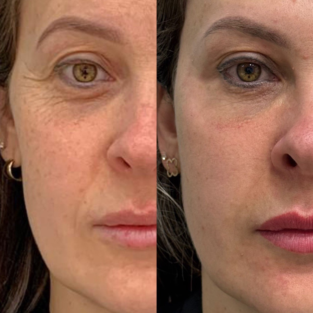 Antes e depois — Clínica Fischer