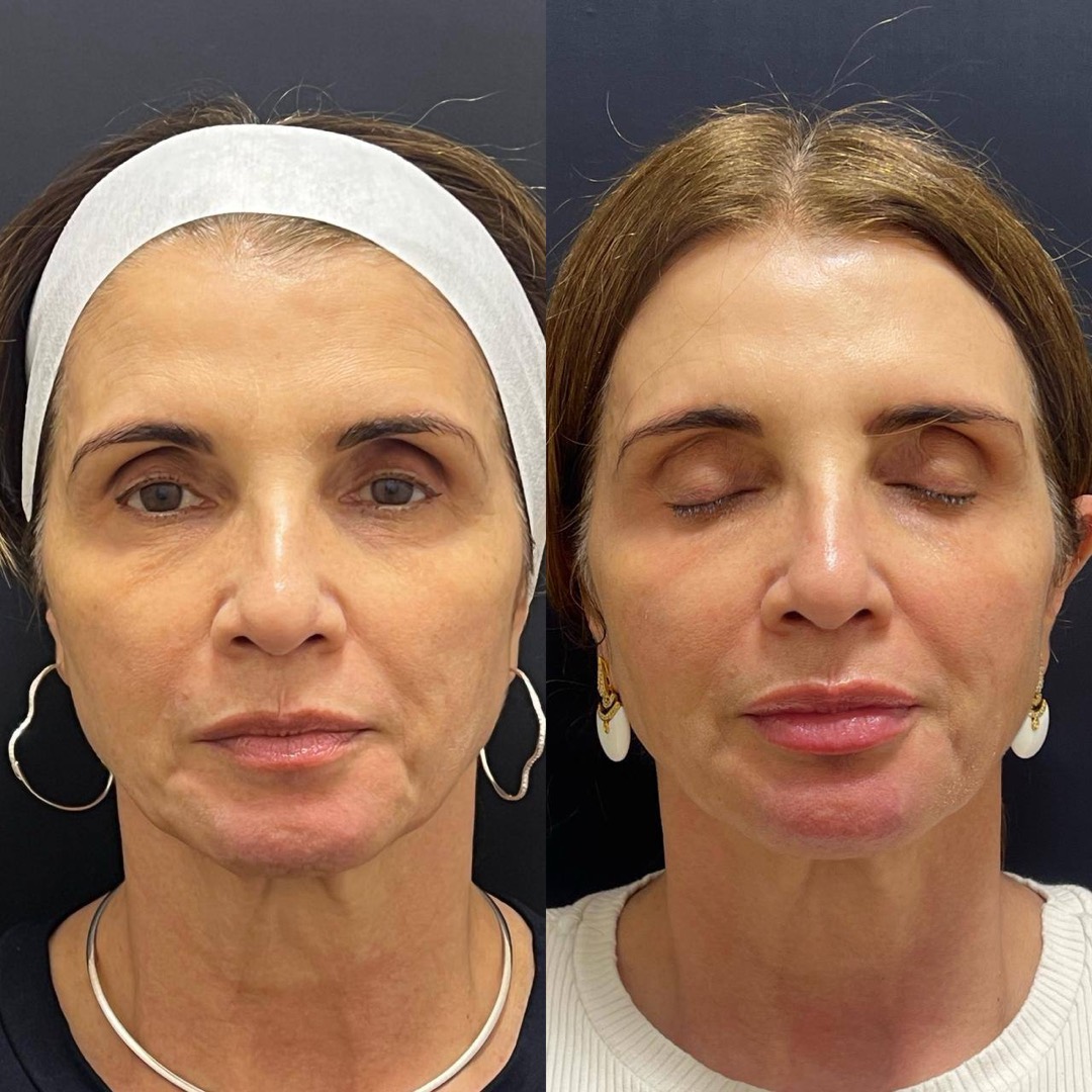 Antes e depois — Clínica Fischer