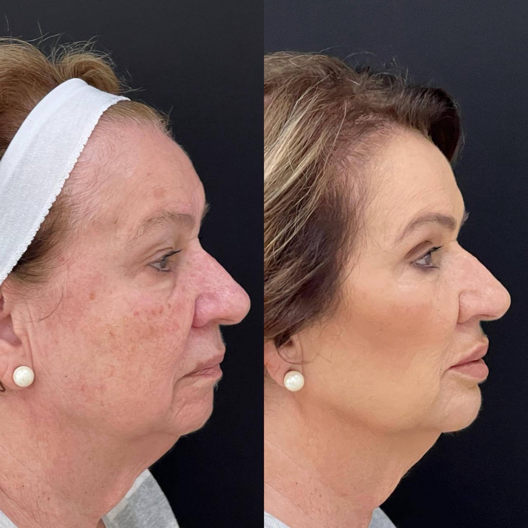 Antes e depois — Clínica Fischer