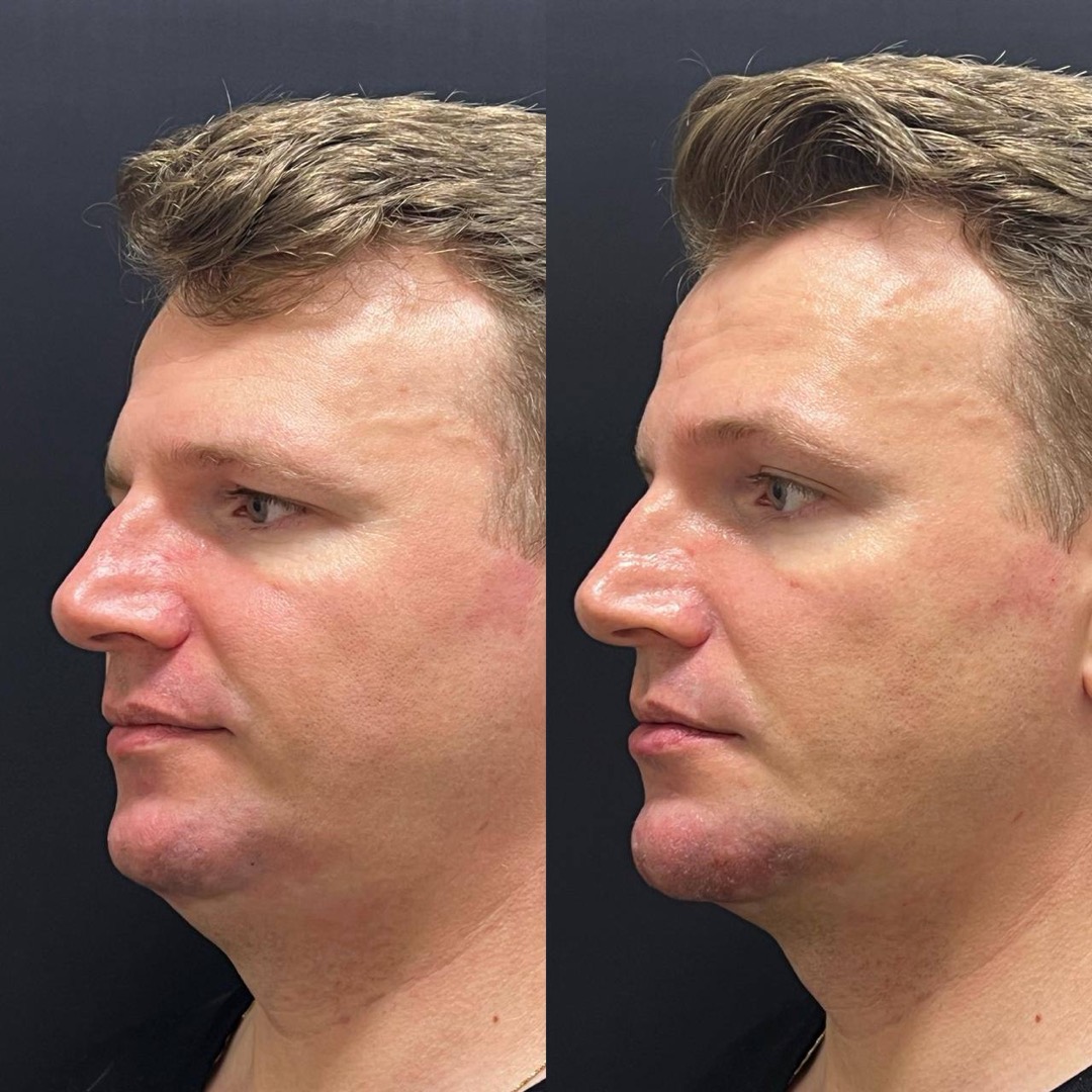 Antes e depois — Clínica Fischer